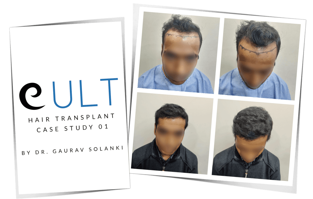 Hair-Transplant-Case-Study-1.png