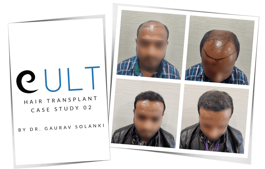 Hair-Transplant-Case-Study-2.png