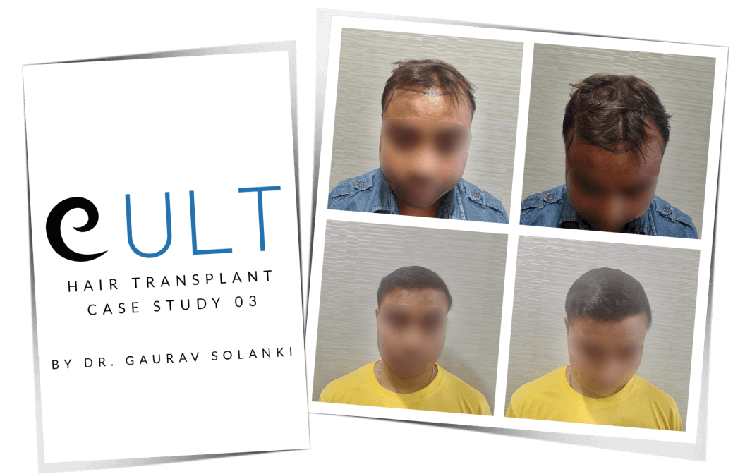 Hair-Transplant-Case-Study-3.png