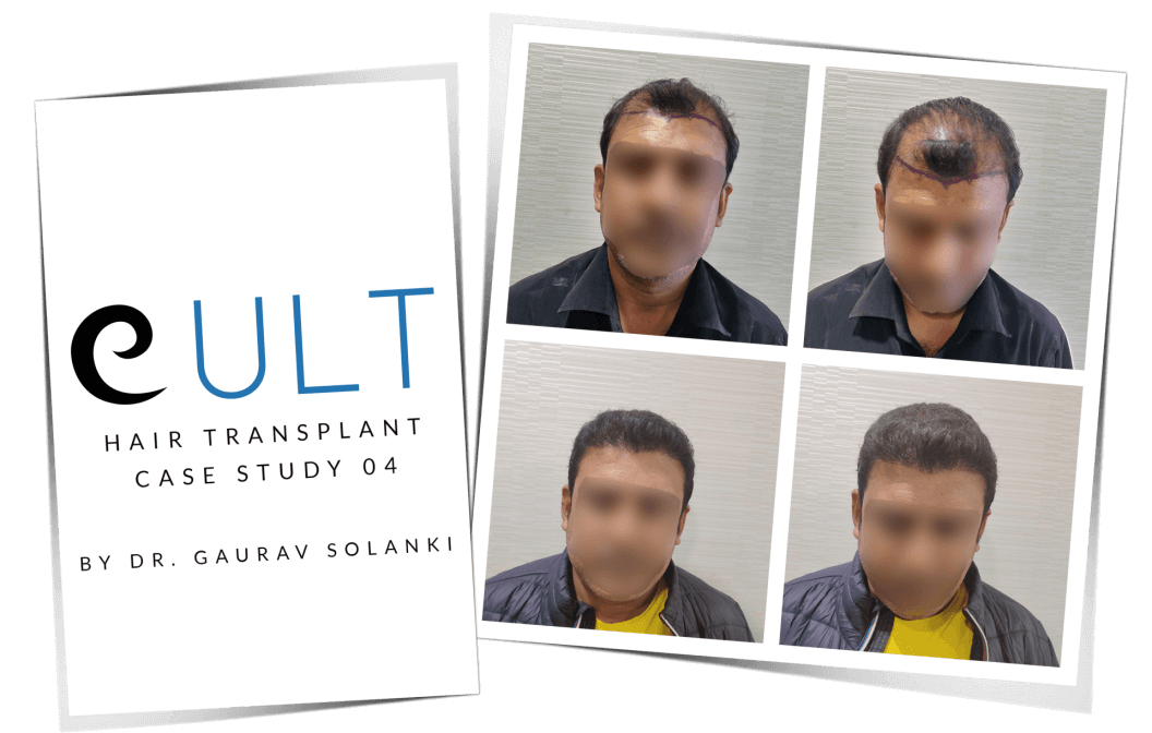 Hair-Transplant-Case-Study-4.png