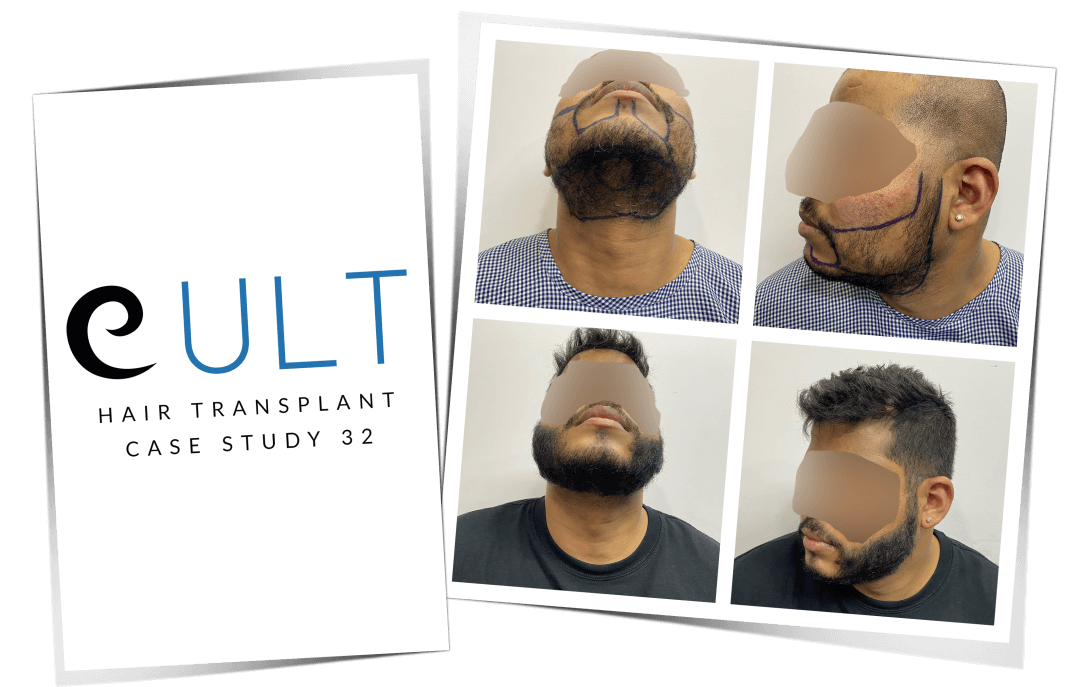 Hair-Transplant-Results-at-Cult-Aesthetics-32-1.png