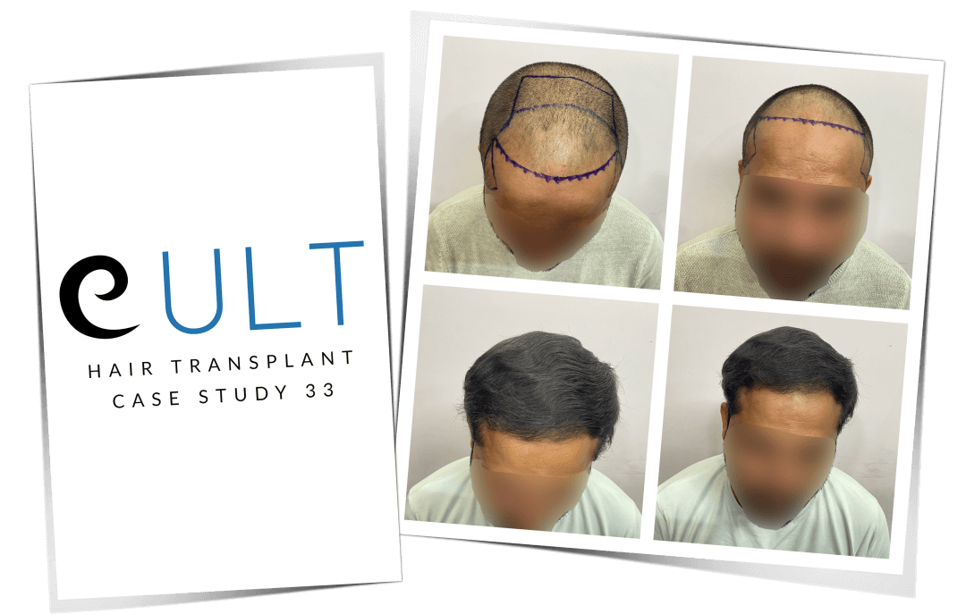 Hair-Transplant-Results-at-Cult-Aesthetics-33-1.png