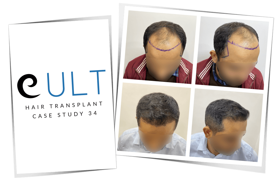Hair-Transplant-Results-at-Cult-Aesthetics-34-1.png